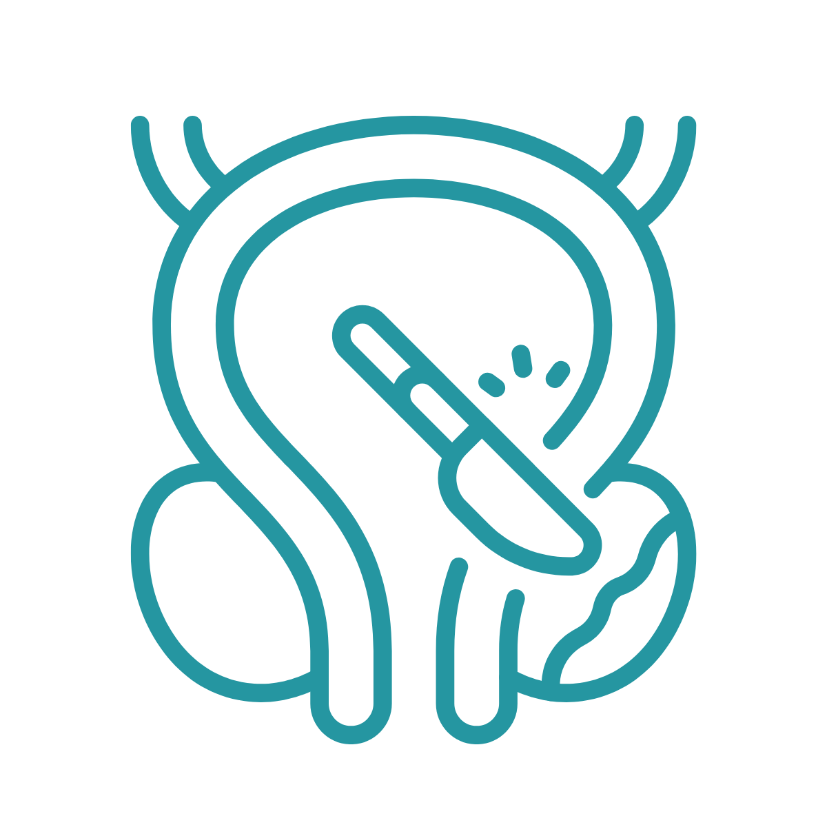 Bladder stone removal (cystotomy) icon